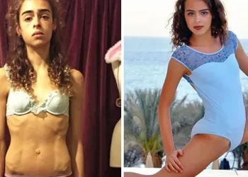 Anoreksiya Hastalığını Yenip Kilo Alanların Yaşadığı Efsanevi Değişimler!