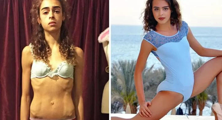 Anoreksiya Hastalığını Yenip Kilo Alanların Yaşadığı Efsanevi Değişimler!