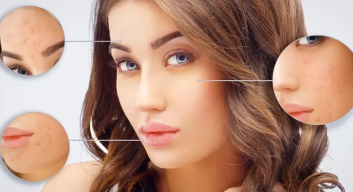 Sivilce Lekelerine Çözüm mü Arıyorsunuz? - Sivilceler İçin Bitkisel Maske Önerileri